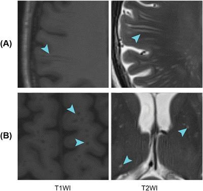 Deep-learning-based segmentation of perivascular spaces on T2-Weighted 3T magnetic resonance images